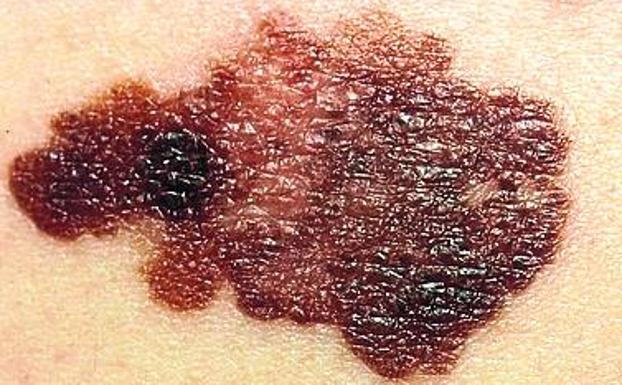 El cáncer de piel más agresivo se dispara entre jóvenes vascos