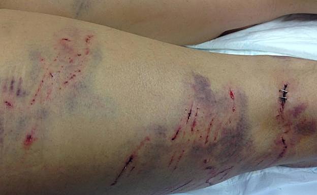 Algunas de las heridas requirieron grapas quirúrgicas. 