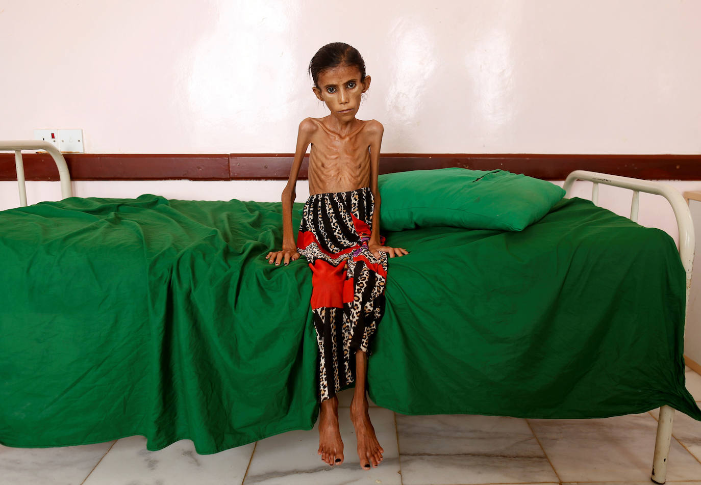 Yemen | Fatima Ibrahim Hadi, de 12 años, se sienta en una cama en una clínica en Aslam, en la provincia noroccidental de Hajjah, Yemen, el 17 de febrero de 2019. 