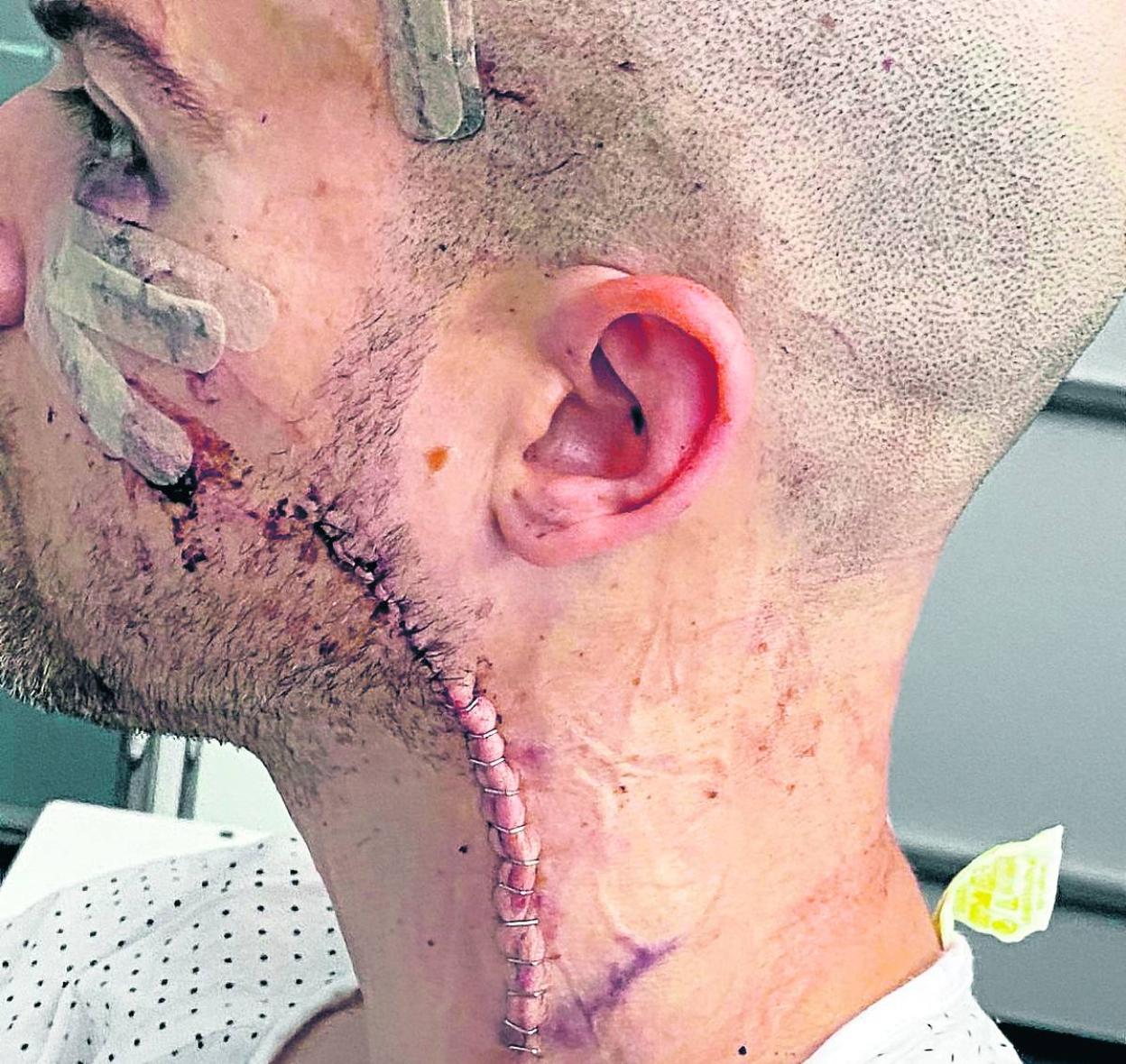 Para cerrar el tajo, los médicos le colocaron quince grapas. 