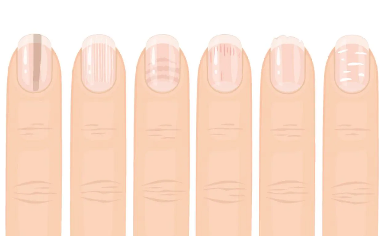 Manchas blancas en las uñas son un síntoma de déficit de calcio  Atida