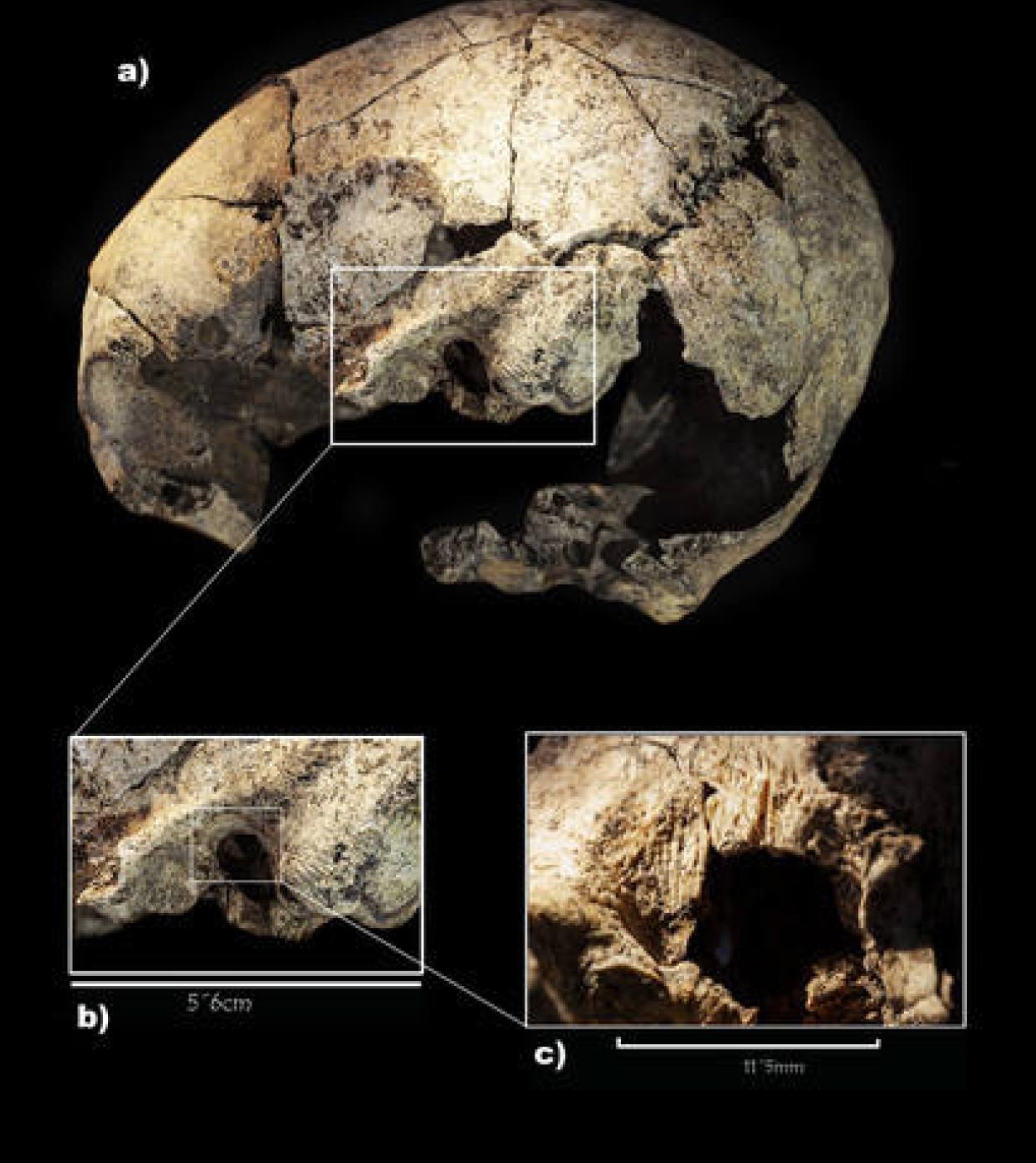 Imagen del cráneo con las incisiones de la operación. 