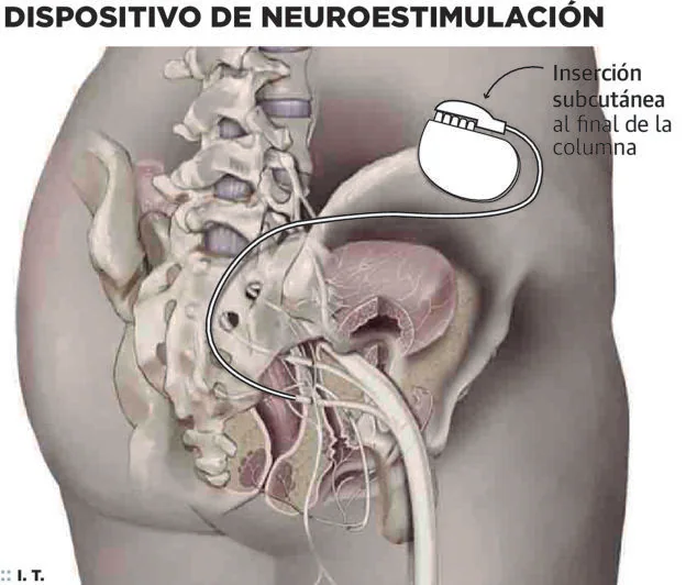 La importancia del suelo pélvico en la Esclerosis Múltiple