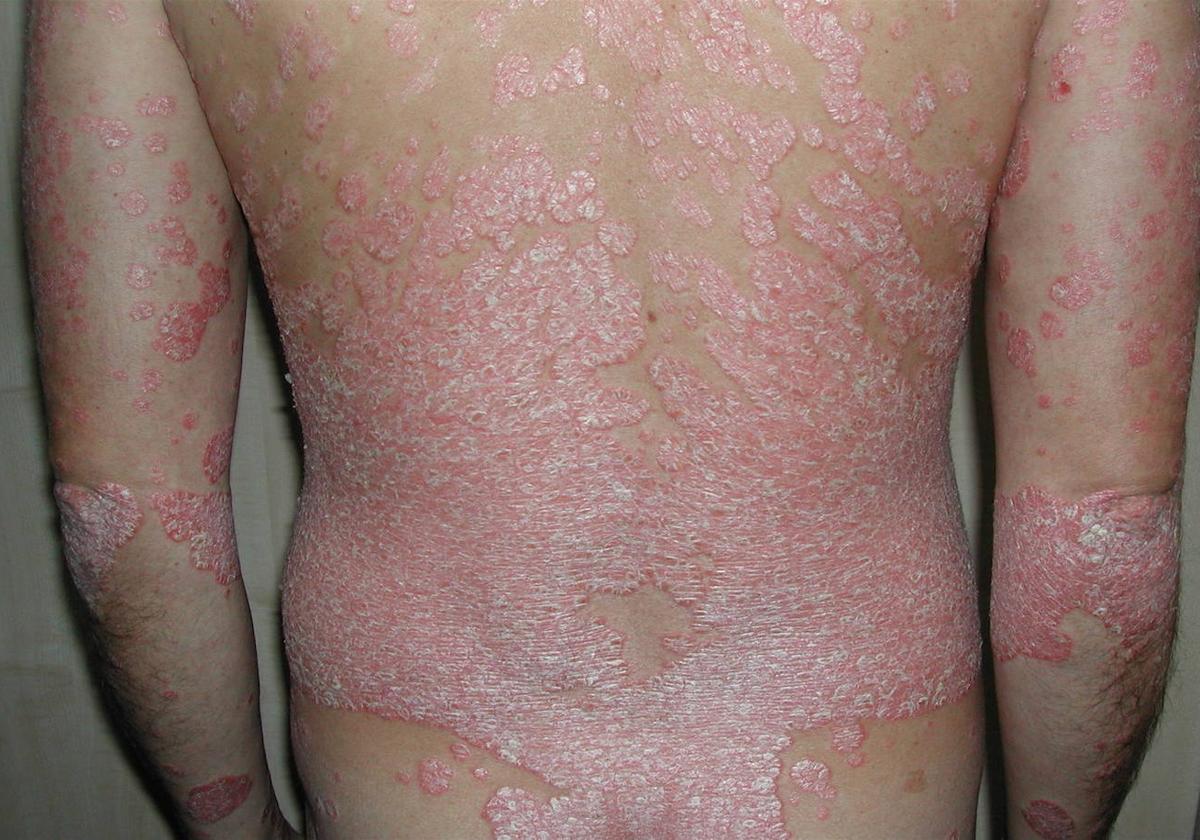Psoriaris, la lucha contra un estigma social: «No contagiamos. Se nos puede tocar y besar»