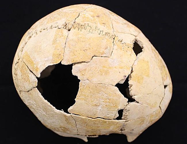 Cráneo con un gran traumatismo realizado por objeto contundente que afectó a los huesos parietales y frontales derechos del cráneo.