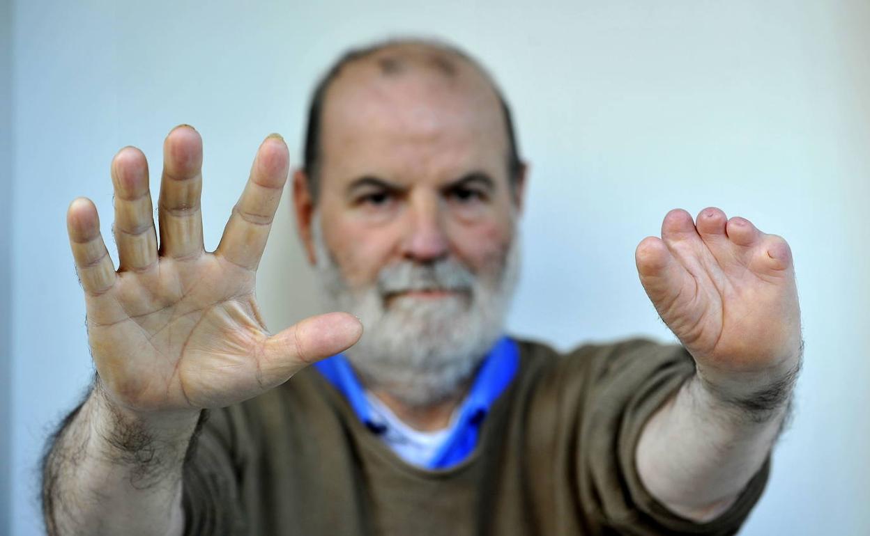 Ramón Ozamiz, afectado por la talidomida, retratado en 2015 por EL CORREO. 