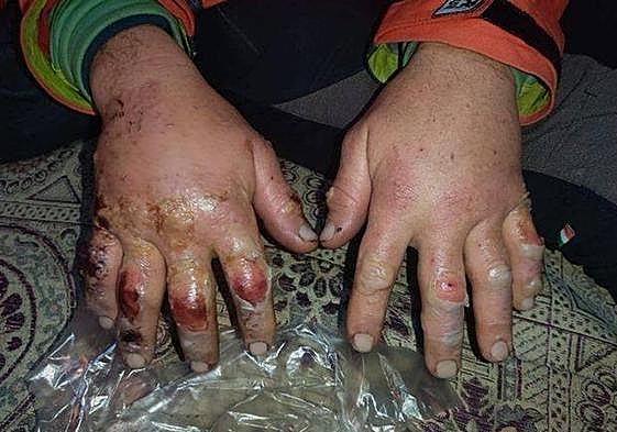 Denis Urubkoren eskuak nola geratu ziren istripuaren ondoren.