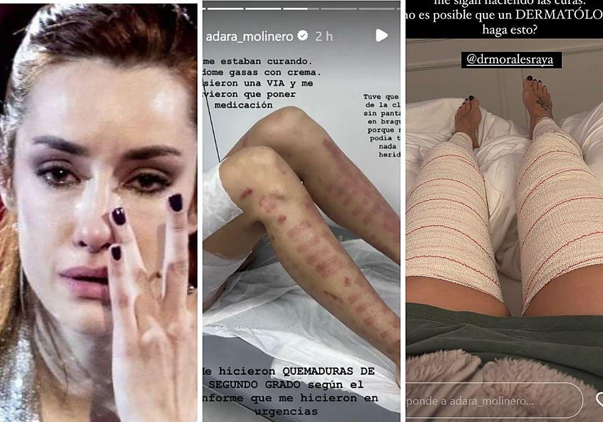 El calvario de Adara Molinero en el dermatólogo: «Tuve que salir sin pantalones por quemaduras de segundo grado»