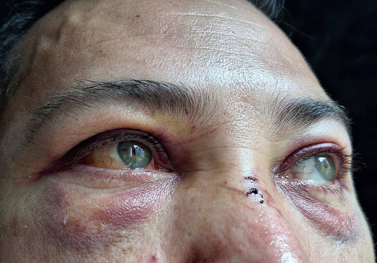 La víctima sufrió graves contusiones por todo el cuerpo y la cara.