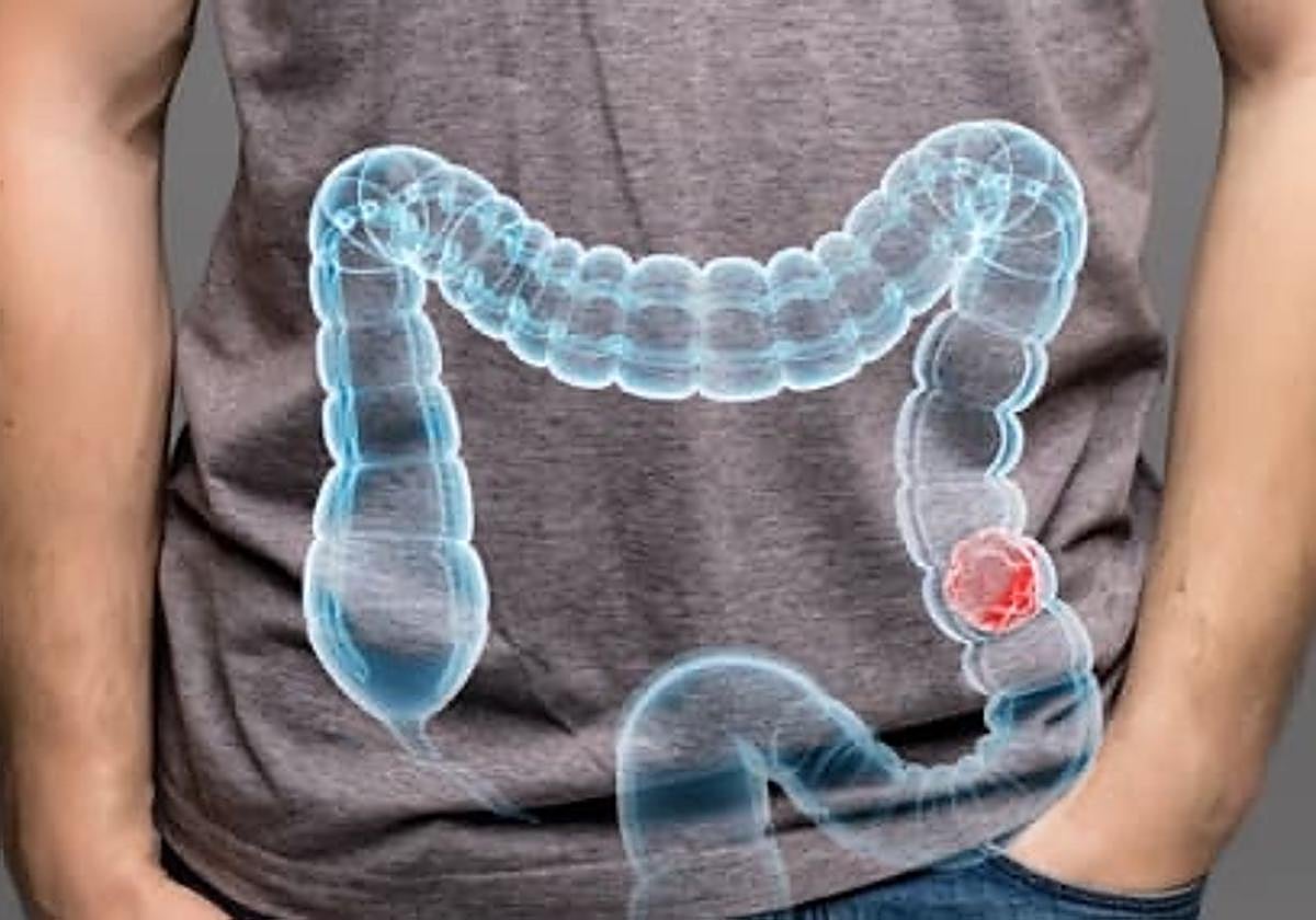 Osakidetza detectó de forma precoz 270 tumores de colon el pasado año