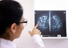 El cáncer de mama es el cuarto tumor que más muertes causó en España en 2023.