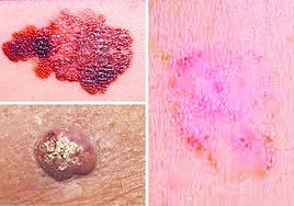 Cómo detectar estos tipos de cáncer de piel: el bueno, el feo y el malo