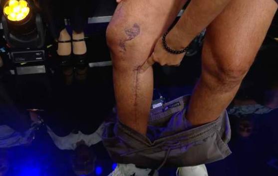 Imagen de las cicatrices en una de sus piernas.