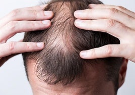 Un hombre se da unas gotas del fármaco contra la alopecia investigado por la agencia europea del medicamento.