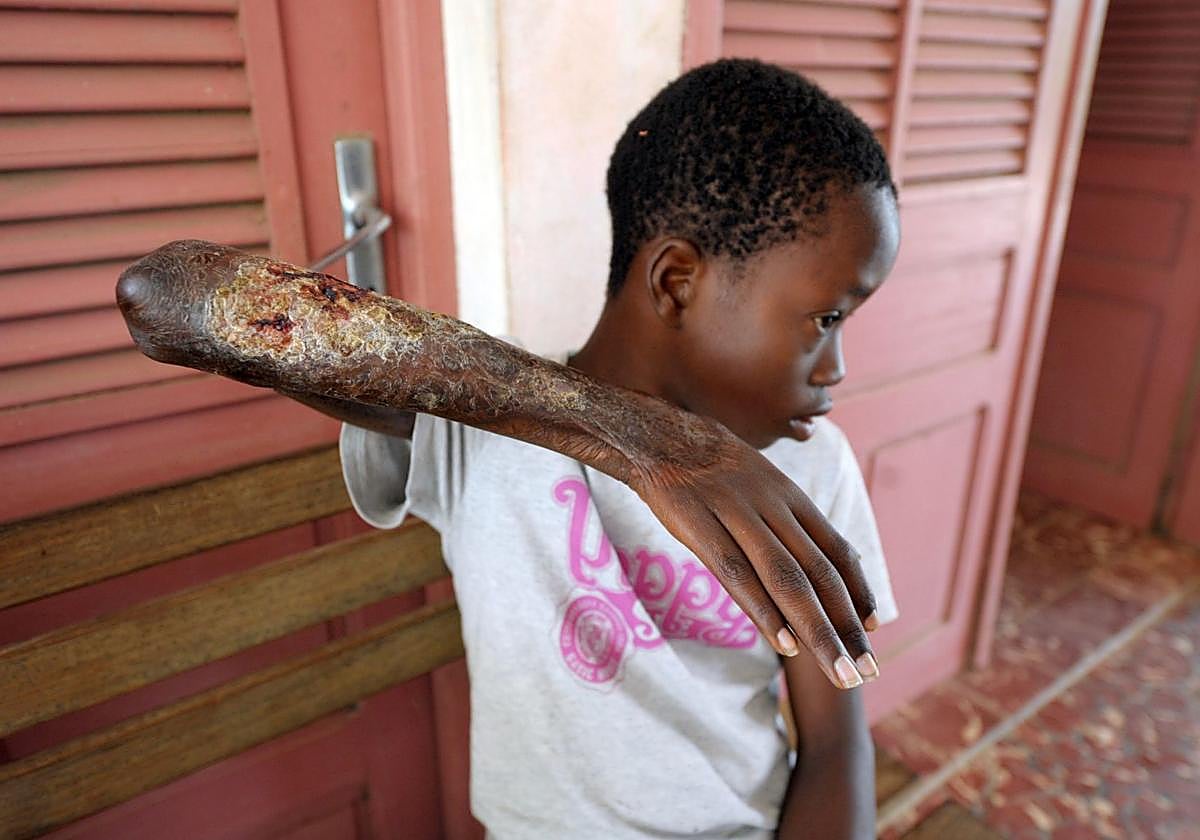 Se registran 200.000 nuevos casos de lepra al año.