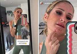 Las llamativas heridas en la cara de Verdeliss tras completar el reto de las siete maratones
