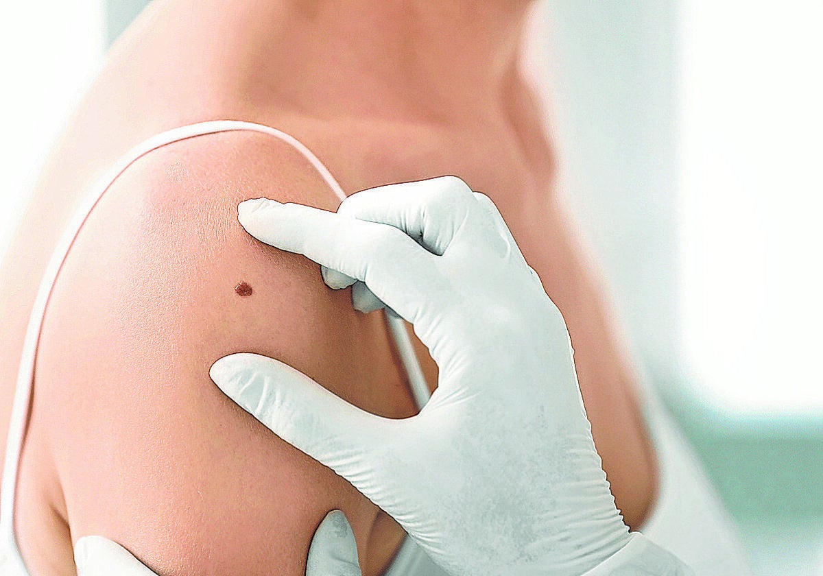 Los diagnósticos de cáncer de piel en Bizkaia se incrementan un 40% desde 2020