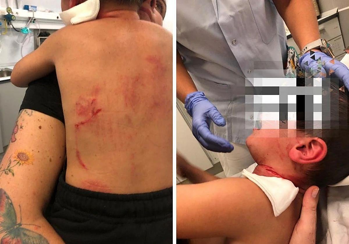 El pequeño Einar, tras sufrir el ataque del perro.