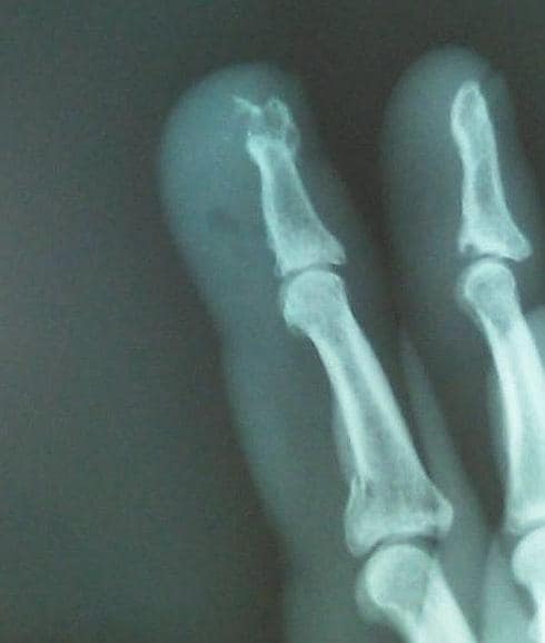 La radiografía confirma que Irujo se ha roto el dedo corazón.