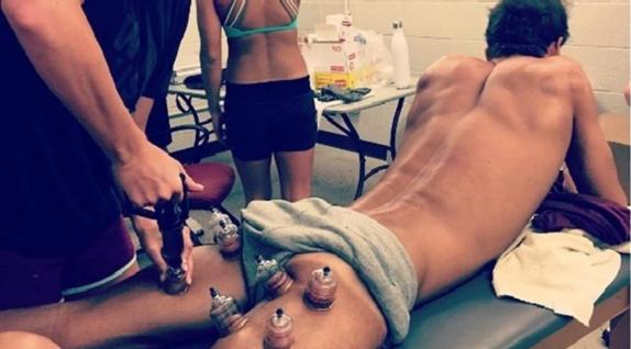 Michael Phelps en plena sesión de cupping.