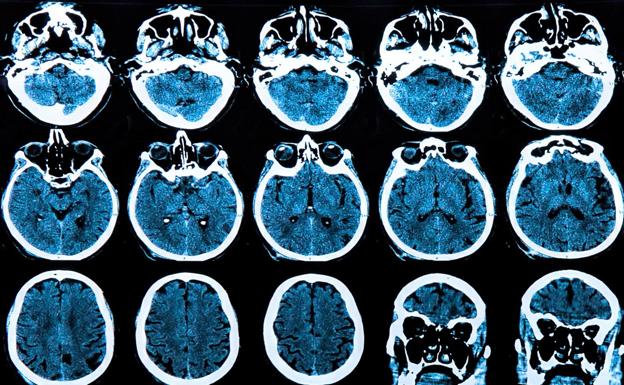 Valdecilla investigará las crisis epilépticas en pacientes en coma con daño cerebral