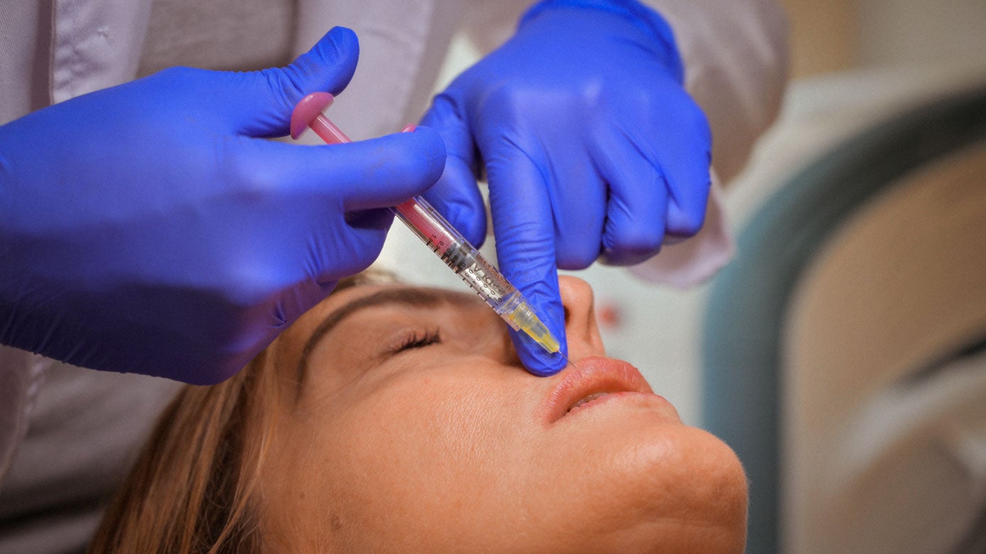 Inyección de ácido hialurónico en el labio superior.