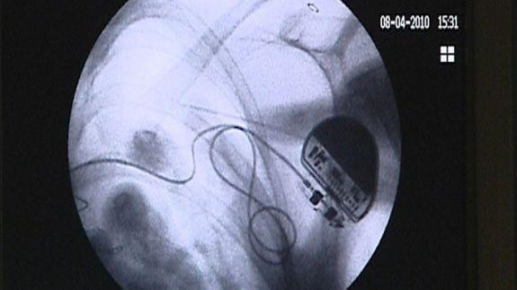 Las primeras pruebas permiten hacer funcionar un marcapasos con esta tecnología