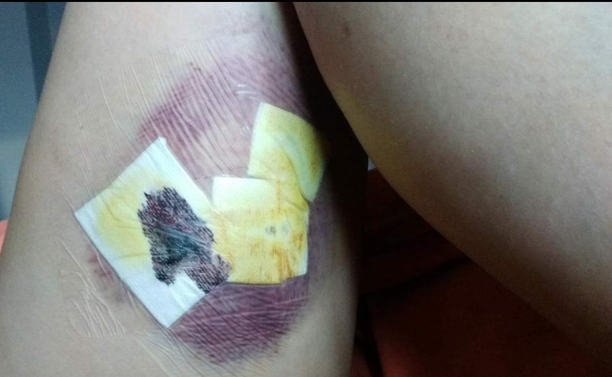 Estado en el que quedó la pierna de la vecina del municipio atacada y mordida por el perro en Sotoverde el pasado mes de junio. 