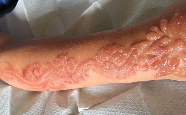 Brazo de la niña tras retirar la 'henna negra'.