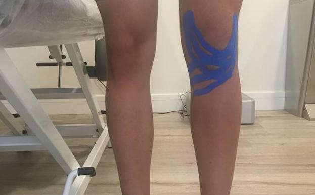 Ejemplo de uso de las 'kinesio tape' para tratar un edema en un esguince de rodilla.