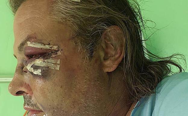 Florencio G. G. con parte de las secuelas de la paliza que sufrió el pasado martes. :: 