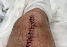 Imagen de la pierna operada con las grapas para cerrar la herida, difundida por el propio Óscar Puente en su cuenta de Twitter.