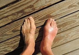 Imagen de archivo de un pie afectado por la retención de líquidos.