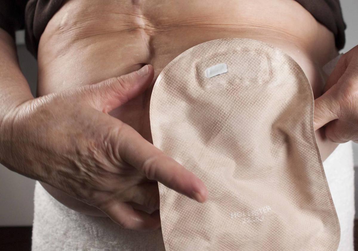 Bolsa de ostomía.