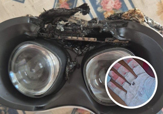 Las gafas de realidad virtual tras arder y una de las heridas causadas en la mano.
