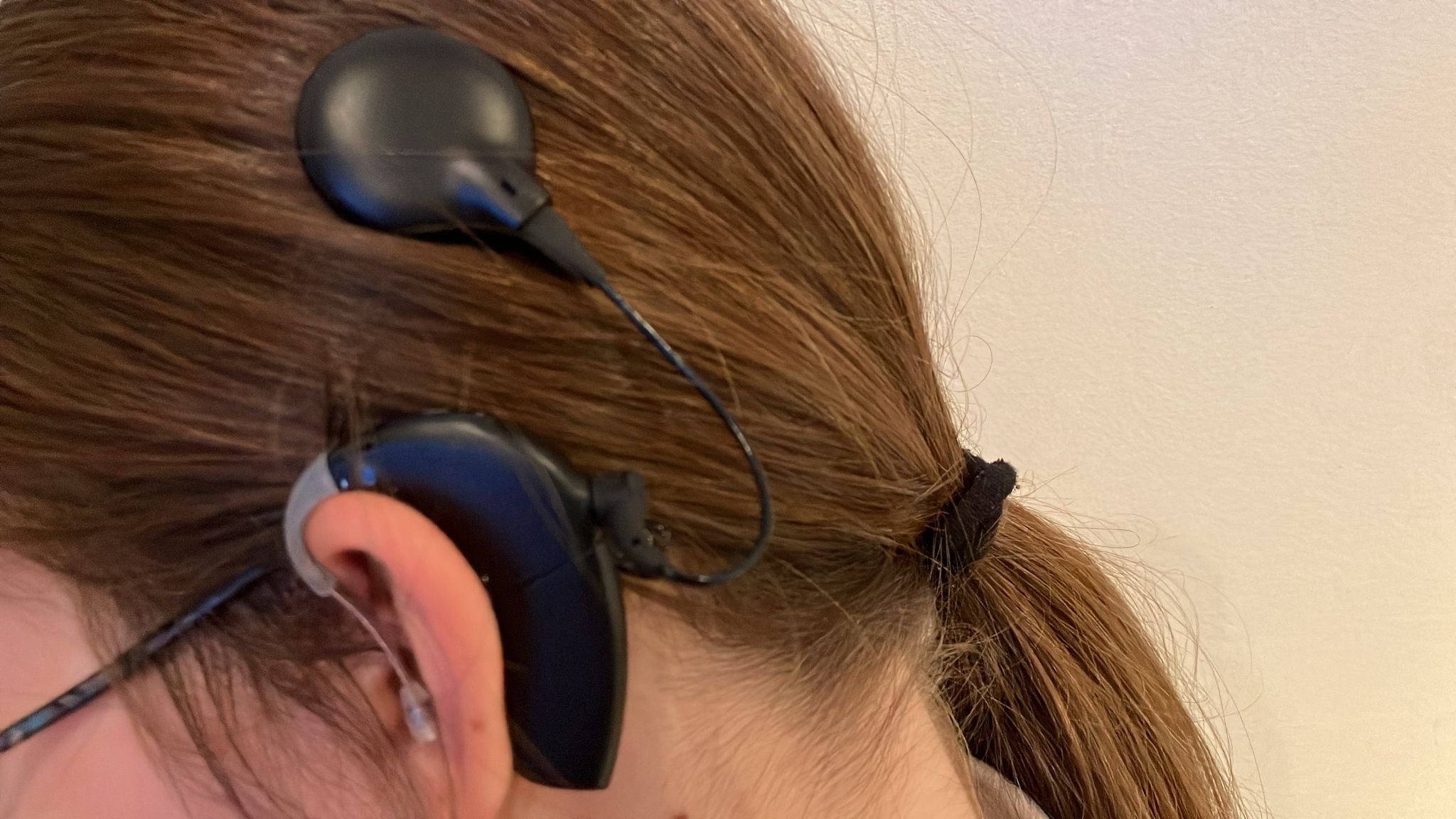 Implante coclear del oído izquierdo de Julia Montero.