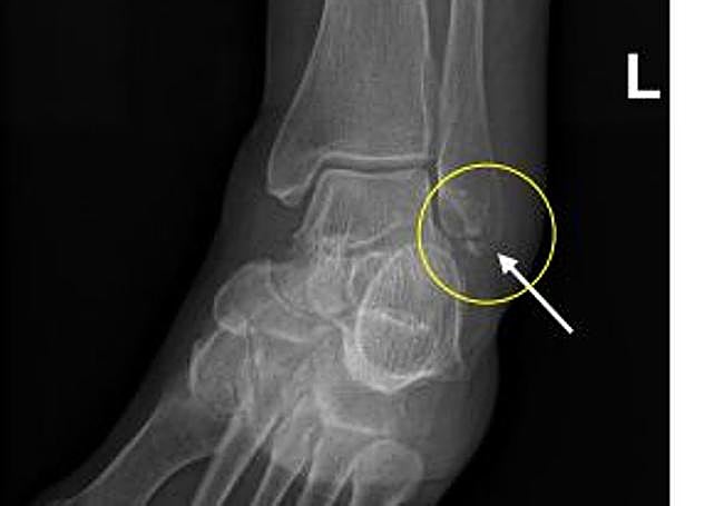 Fractura que sufrió la viandante.