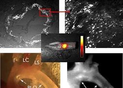 Visualizan por primera vez la formación de la ateroesclerosis en las arterias
