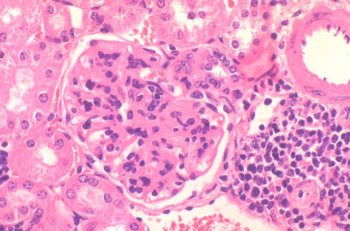 Imagen representativa de glomerulonefritis autoinmune característica de ratones con lupus eritematoso sistémico.