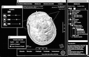 Un atlas informático permitirá ver el cerebro y diagnosticar el Parkinson