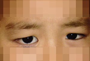 El pequeño tiene una cicatriz en su ojo derecho, que le llora con frío o sol y parpadea constantemente para aliviar los picores que sufre. ::                             EL NORTE