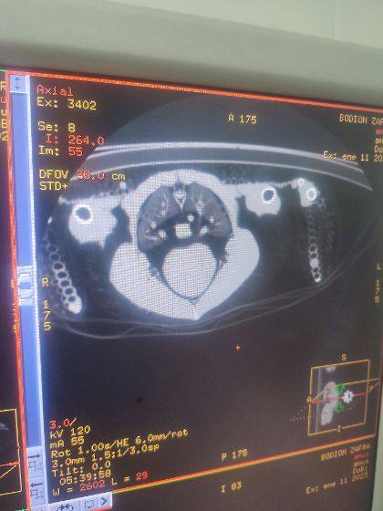 Evidencia de un hematoma en cerebro. 