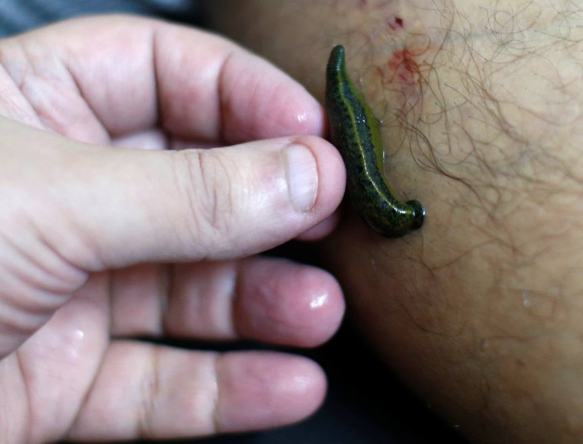 La terapia de ahuecamiento Hijama