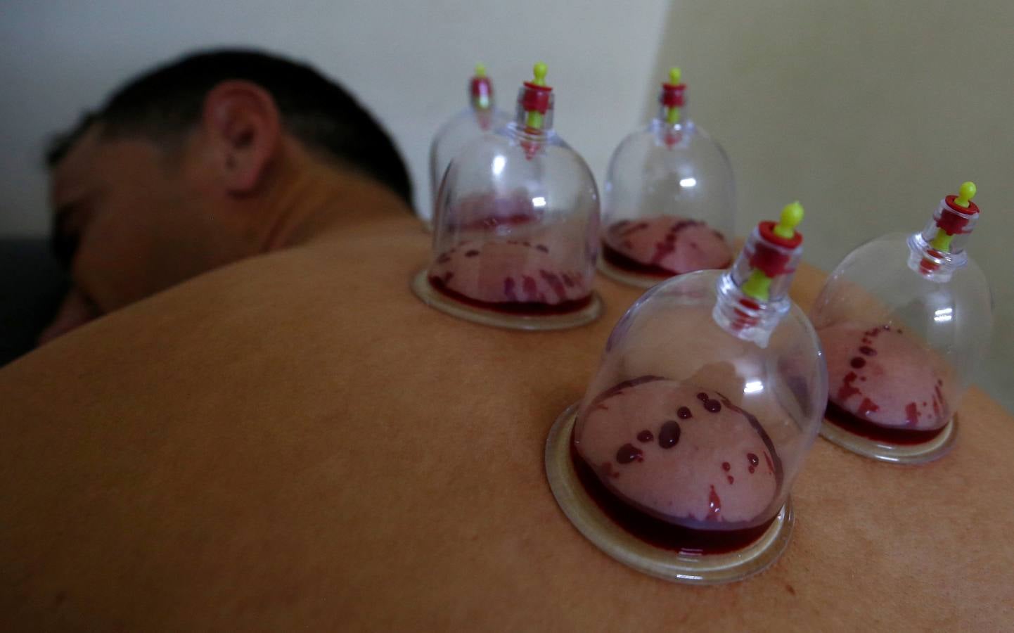 La terapia de ahuecamiento Hijama