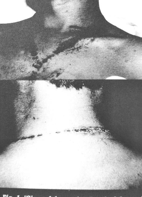 Imagen - 'Signo del exorcista' en un joven que sobrevivió a un rayo en Cáceres. La cadena con una luz que llevaba se fundió.