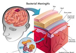 Meningitis: Cuáles son sus síntomas, cómo se contagia y cómo tratarla