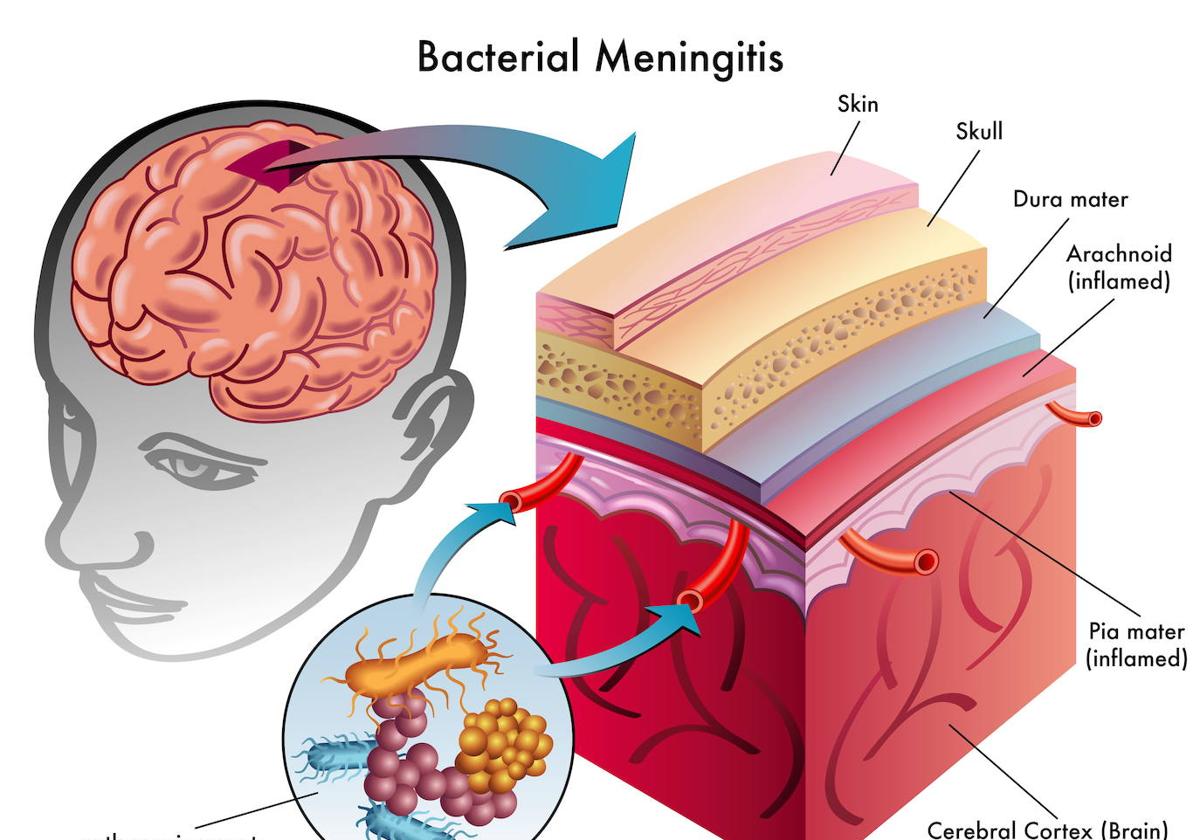 Meningitis: Cuáles son sus síntomas, cómo se contagia y cómo tratarla | Hoy