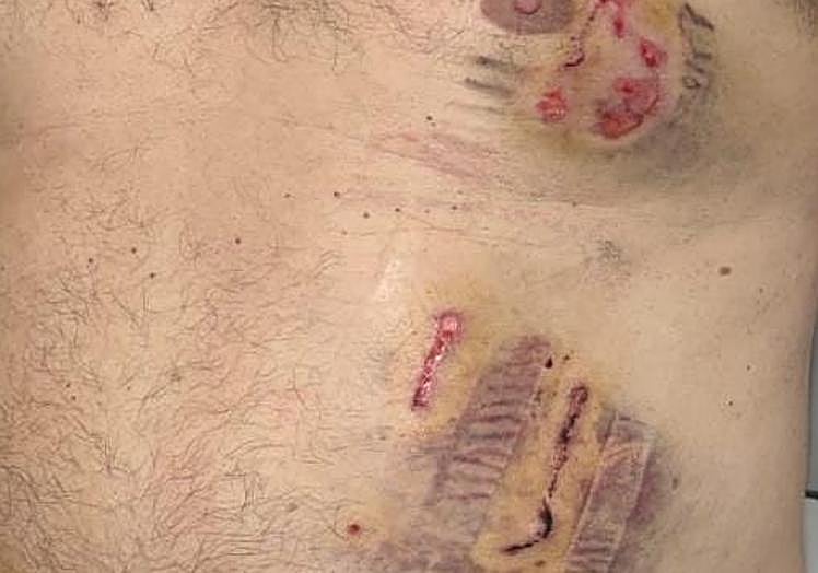 Heridas que tiene Antonio Fernández en el cuerpo a causa de las mordeduras del perro.