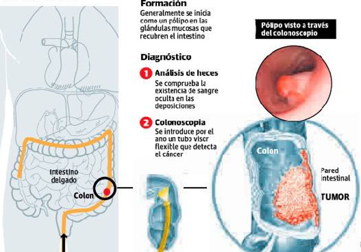 En Extremadura se diagnosticaron 964 casos de cáncer de colon en 2023.