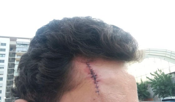 Cicatriz de Leonardo Hernández tras su operación para superar el cáncer de piel